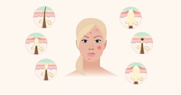 Диагностика типа акны перед лечением в косметологической клинике в Калуге С Тетик