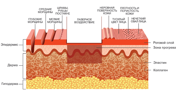 Принцип RF воздействия на слои эпидермиса и дермы лица при шлифовке лазером MCL 31 Dermablate в центре аппаратной косметологии в Калуге С-Тетик