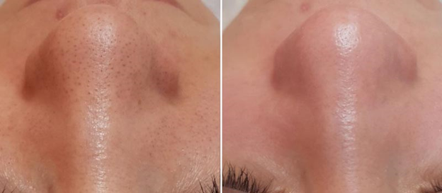Результат до и после чистки лица ультразвуком на профессиональном оборудовании в косметологической клинике в Калуге с Тетик