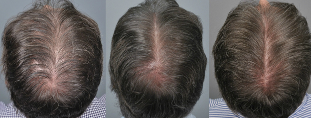 Наглядный эффект от мезотерапии для волос после третьего курса инъекций в кожу головы