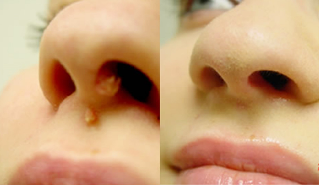 До и после удаления бородавок лазером на лице у пациентки из Калуги в косметологии С Тетик